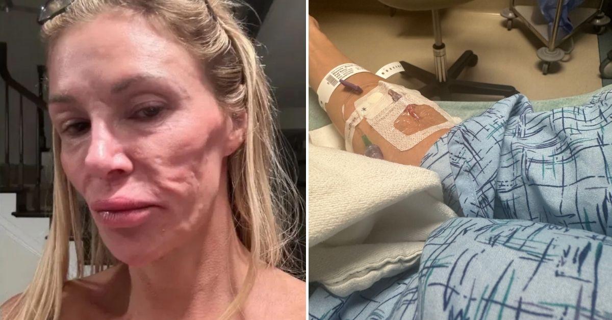 Brandi Glanville rushed to the hospital in the midst of 'parasite' face struggle