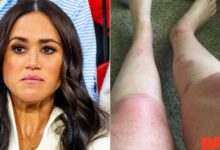 Burn -Vlachtoffer claims that Meghan Markle was aware of the label responsibilities