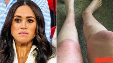Burn -Vlachtoffer claims that Meghan Markle was aware of the label responsibilities