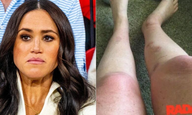 Burn -Vlachtoffer claims that Meghan Markle was aware of the label responsibilities