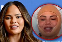 Chrissy Teigen reveals facial surgery during Instagram Live Stream