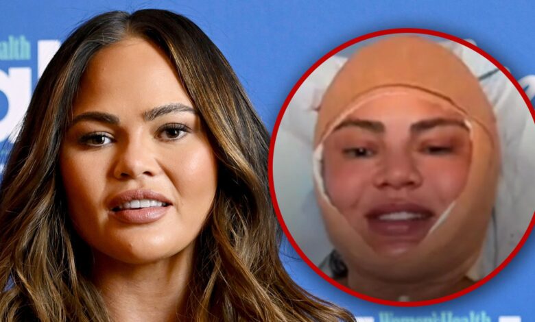 Chrissy Teigen reveals facial surgery during Instagram Live Stream