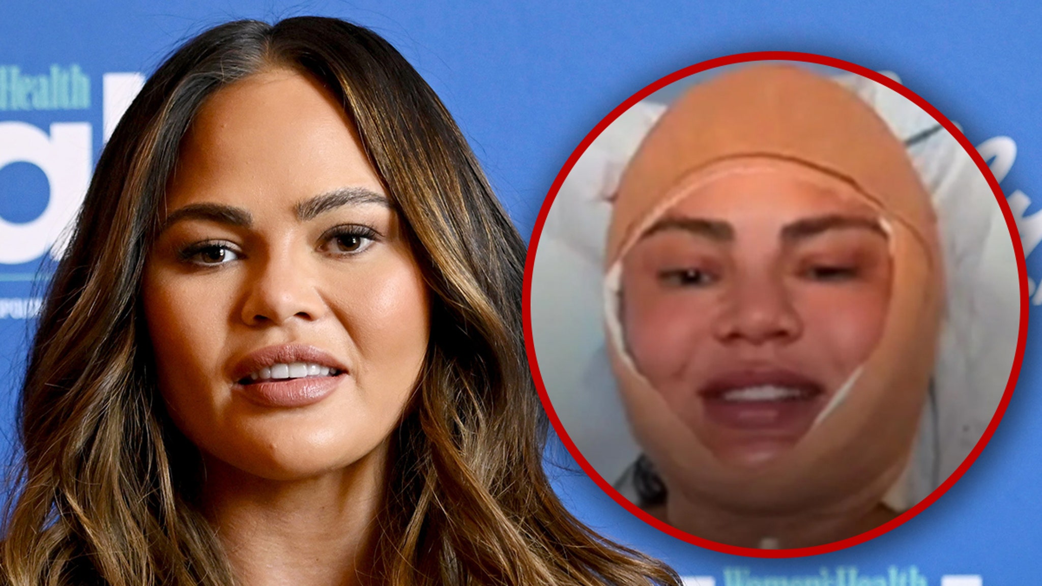 Chrissy Teigen reveals facial surgery during Instagram Live Stream