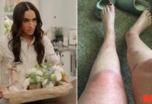 Meghan Markle Fan to sue Duchess after the suffering of 'catastrophic' Burns'