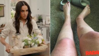 Meghan Markle Fan to sue Duchess after the suffering of 'catastrophic' Burns'