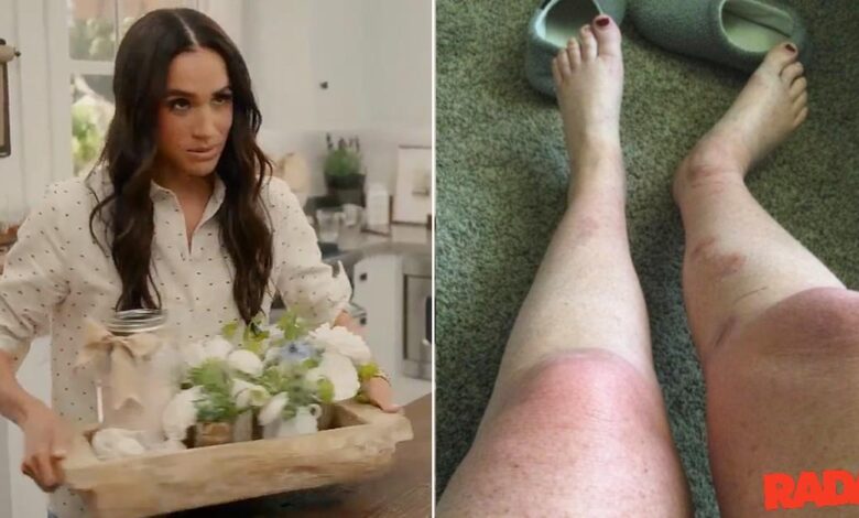 Meghan Markle Fan to sue Duchess after the suffering of 'catastrophic' Burns'