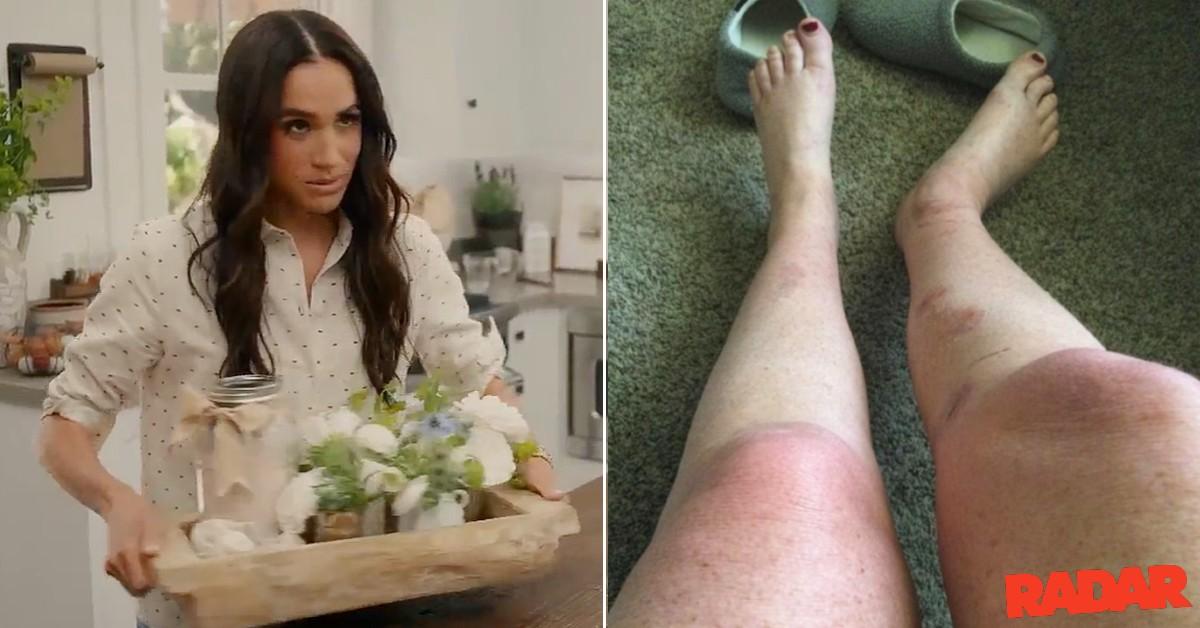 Meghan Markle Fan to sue Duchess after the suffering of 'catastrophic' Burns'