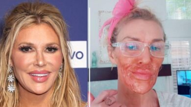 Burns face with hair removal cream