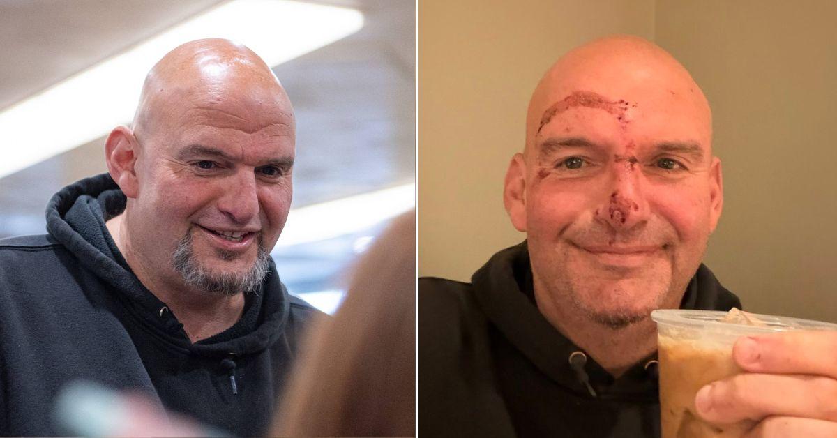 John Fetterman shows off horrific stabs and facial injuries after fall