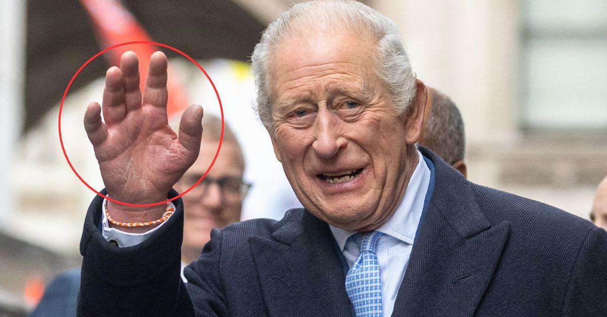 Why King Charles's cancer-fighting fingers are so swollen