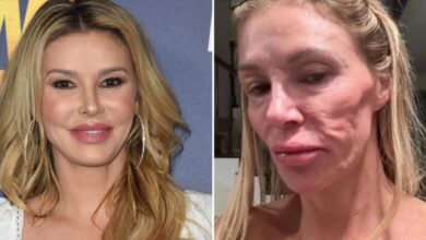 A look inside Brandi Glanville's facial parasite terror that stunned doctors