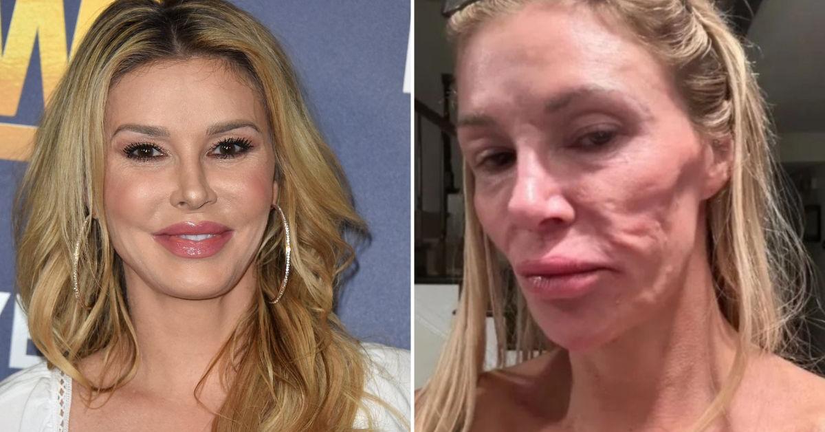 A look inside Brandi Glanville's facial parasite terror that stunned doctors