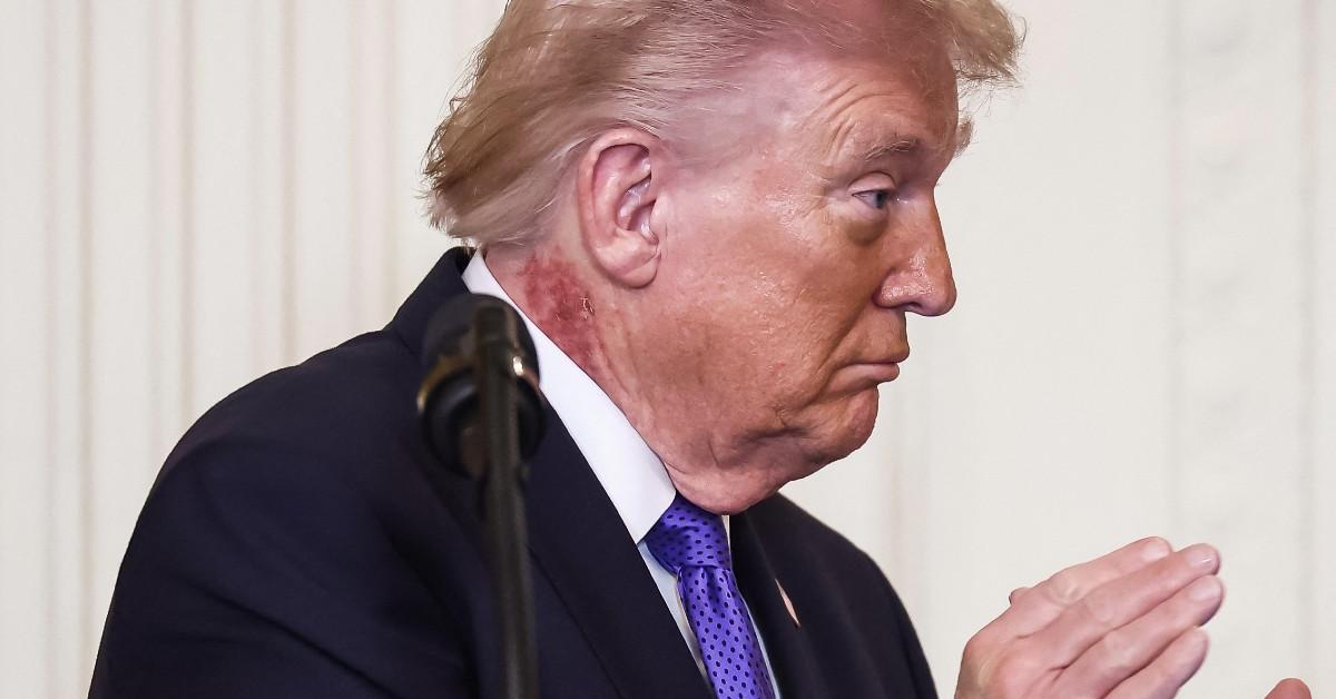 Trump's neck rash labeled 'precancerous skin condition' by celebrity doc